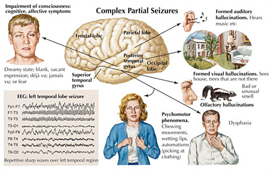 Epilepsy Complex Partial Seizures