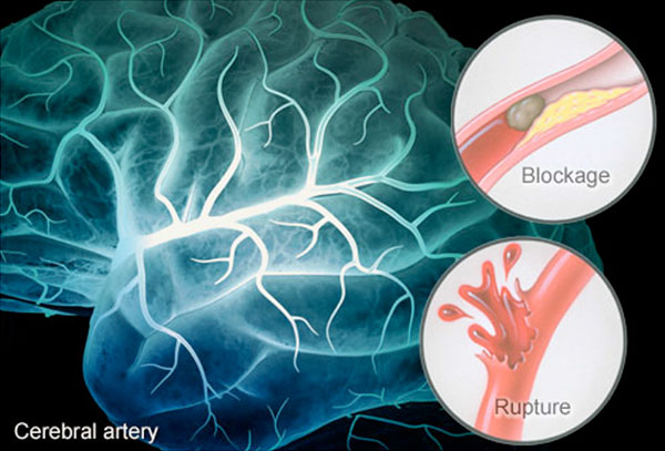 Cerebral Artery Diagram