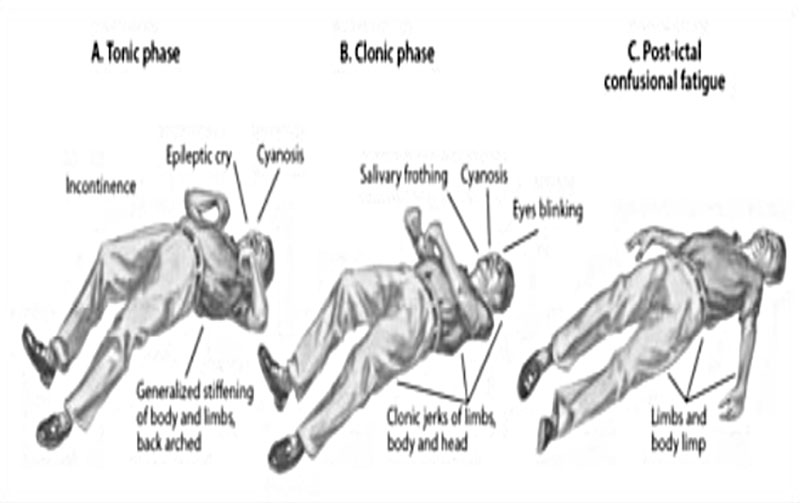 Epilepsy Seizure illustration